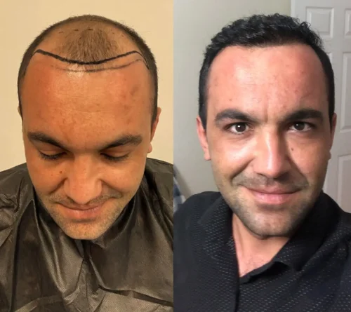 4500 grafts hair transplant result