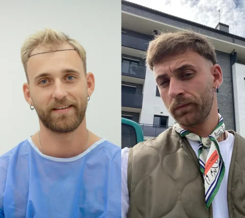 500 grafts hair transplant before after result