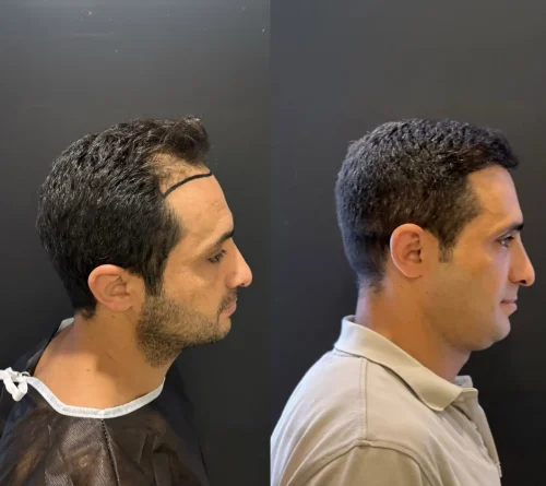 5500 grafts hair transplant clinic london