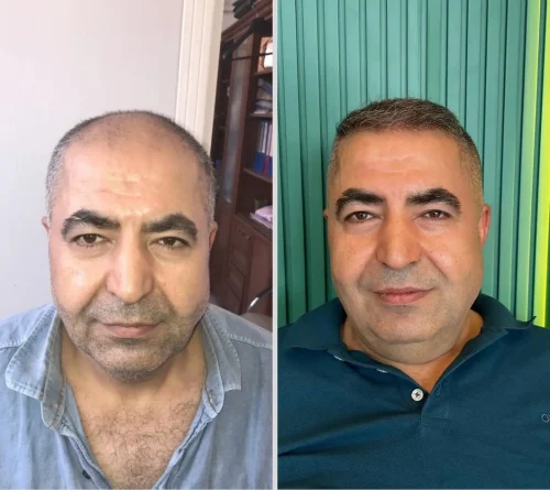 6 months 5500 grafts