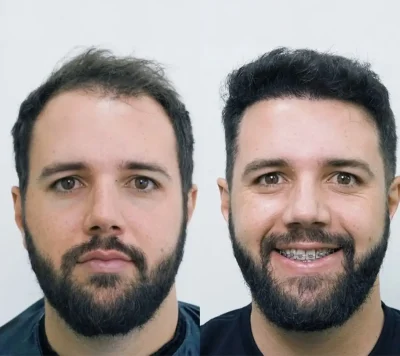 Hair Transplant 3500 grafts 5 months