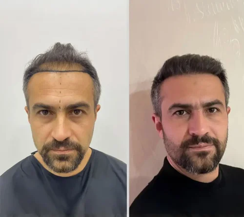 Hair Transplant 4000 Grafts 6 months