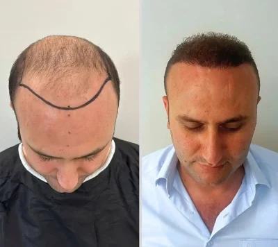 Hair Transplant 5000 grafts 6 months