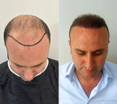Hair Transplant 5000 grafts 6 months
