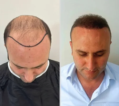 Hair Transplant 5000 grafts 6 months