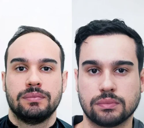 Hair Transplant 5500 grafts 8 months