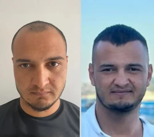 London 4000 hair transplant grafts 6 months