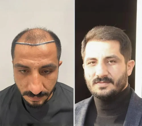 London Clinic 4500 grafts hair transplant 6 months