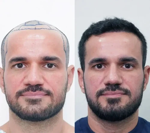 London Hair Transplant 6 months 5500 grafts