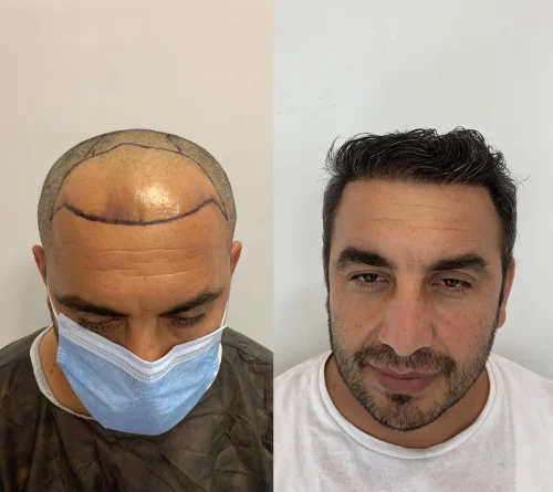 dhi hair transplant before after result