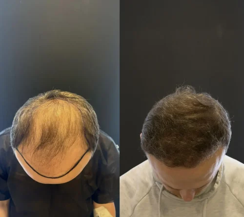 fue 5500 grafts hair transplant before after result