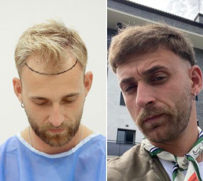 fue hair transplant patient london