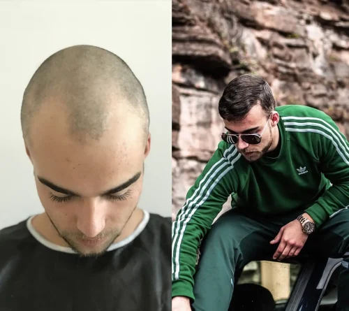 hair fue transplant before after result
