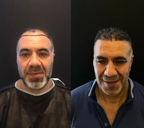 hair transplant before after result
