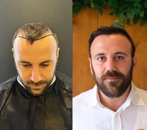 hair transplant clinic london beofre after
