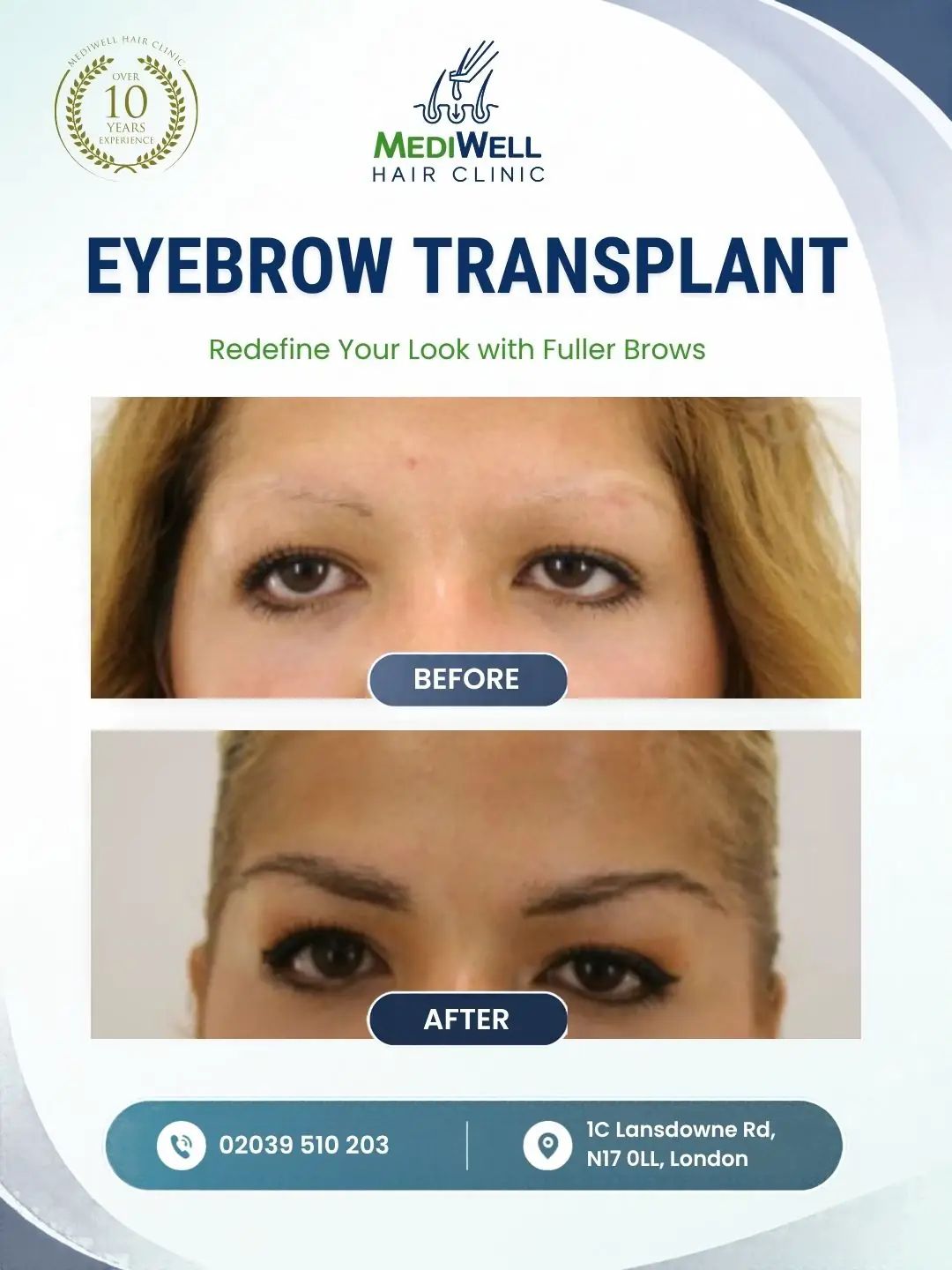 eyebrow transplant before after
