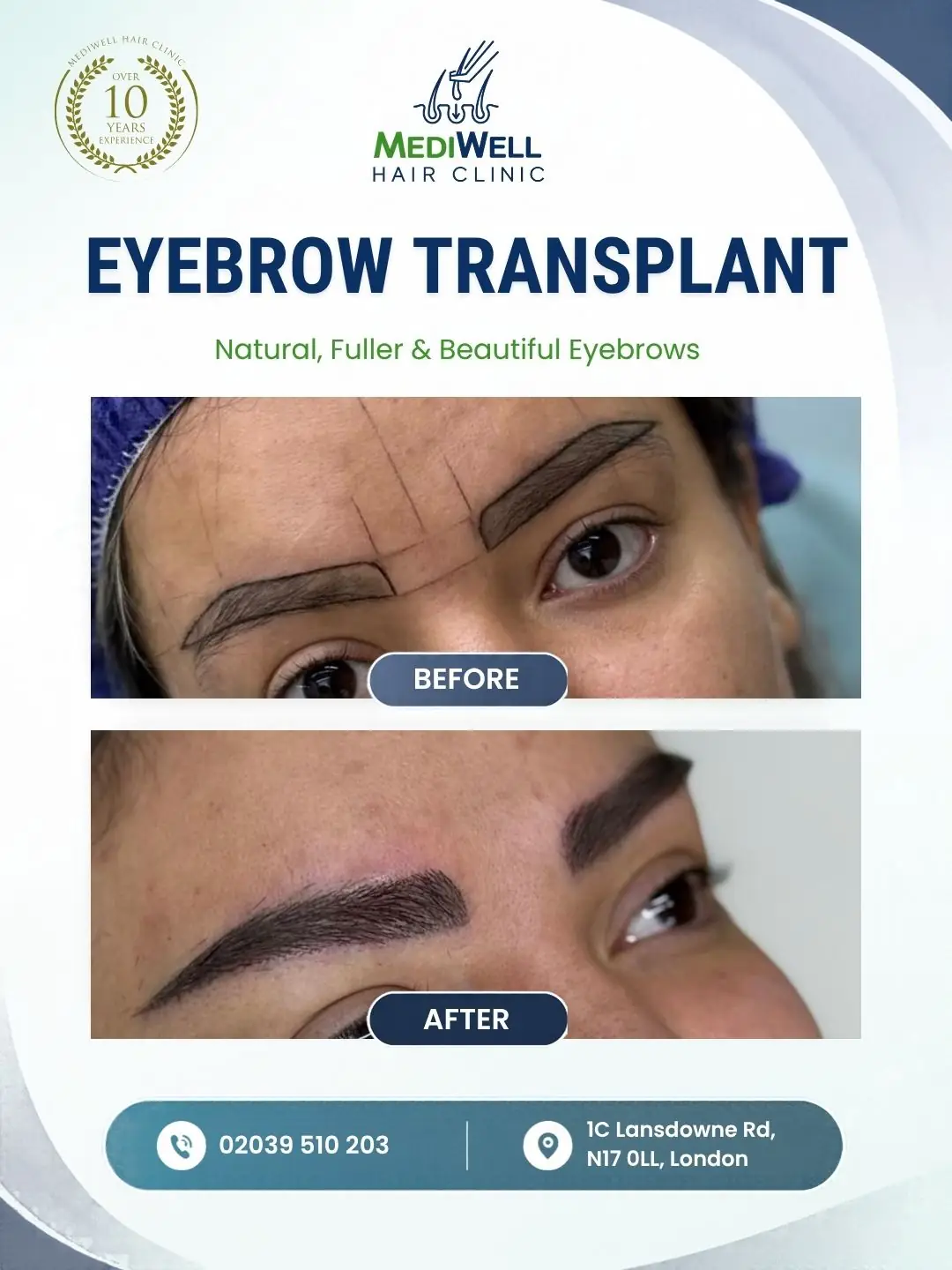 eyebrow transplant before after