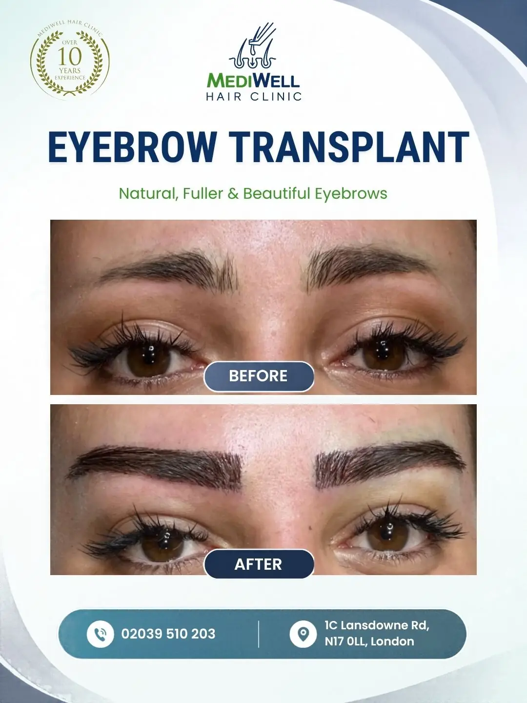 eyebrow transplant before after