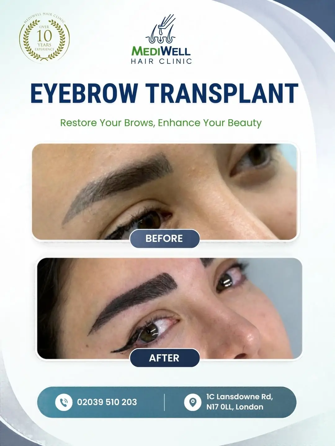 eyebrow transplant before after