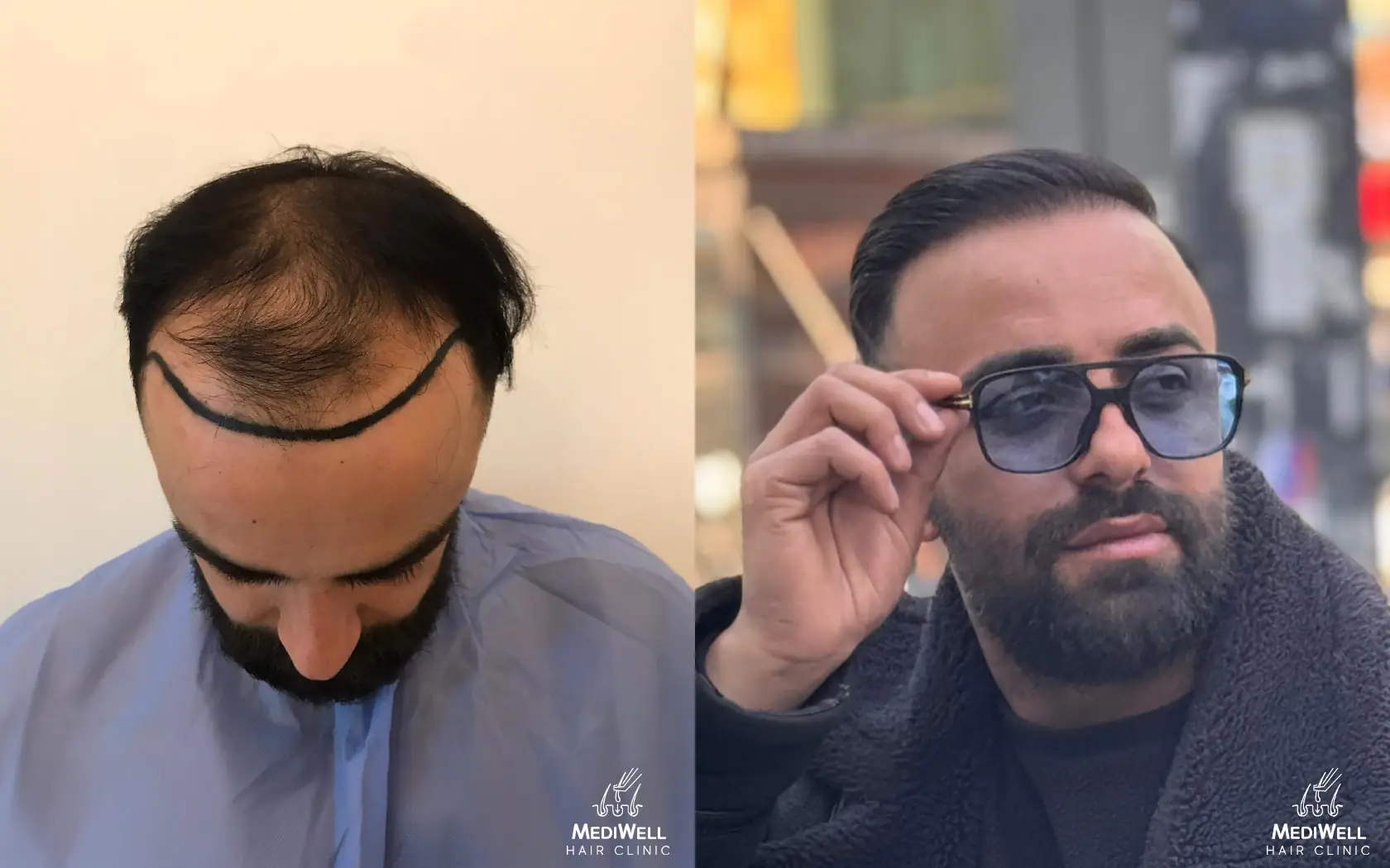 fue hair transplant patient london
