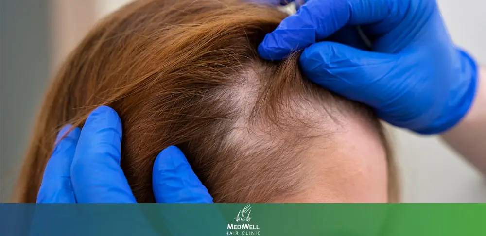 hair loss women