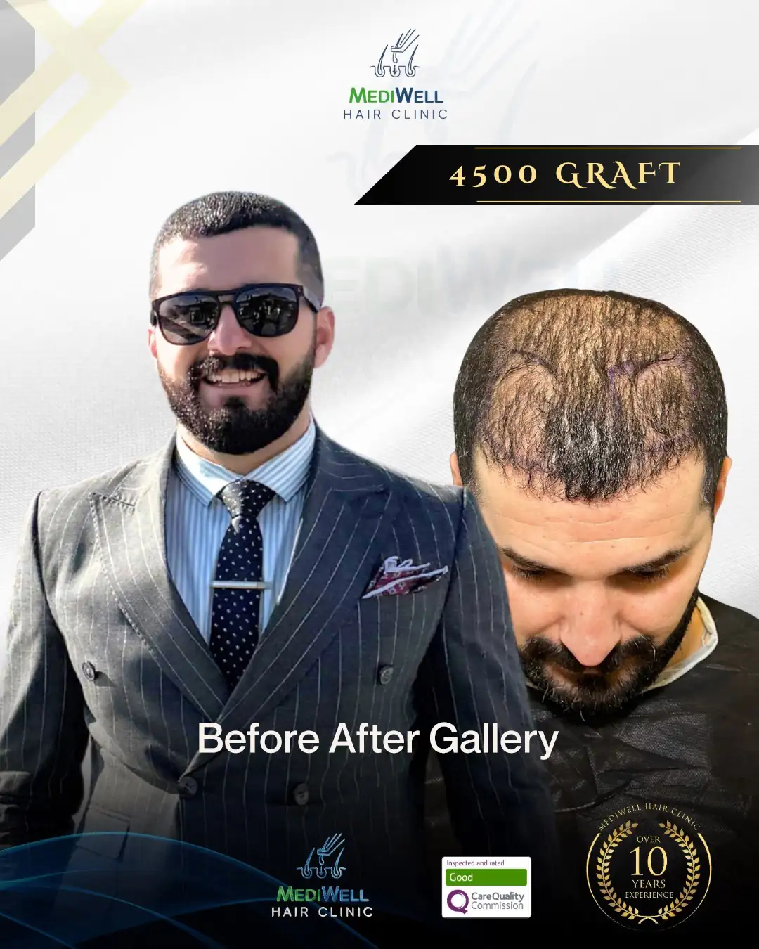 hair transplant before and after gallery