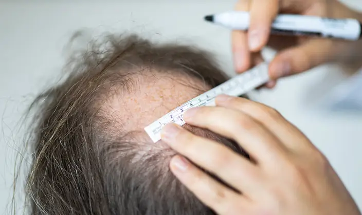 london dhi hair transplant