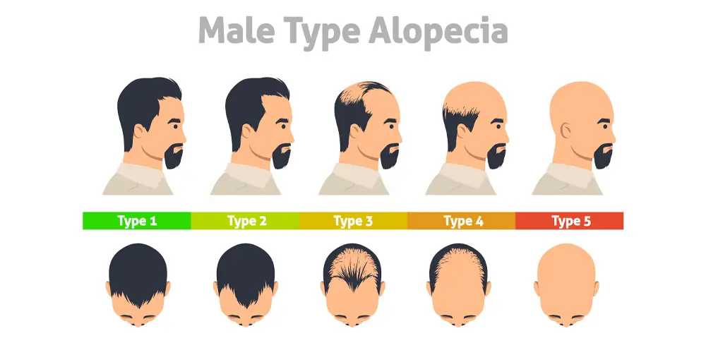 male type alopecia